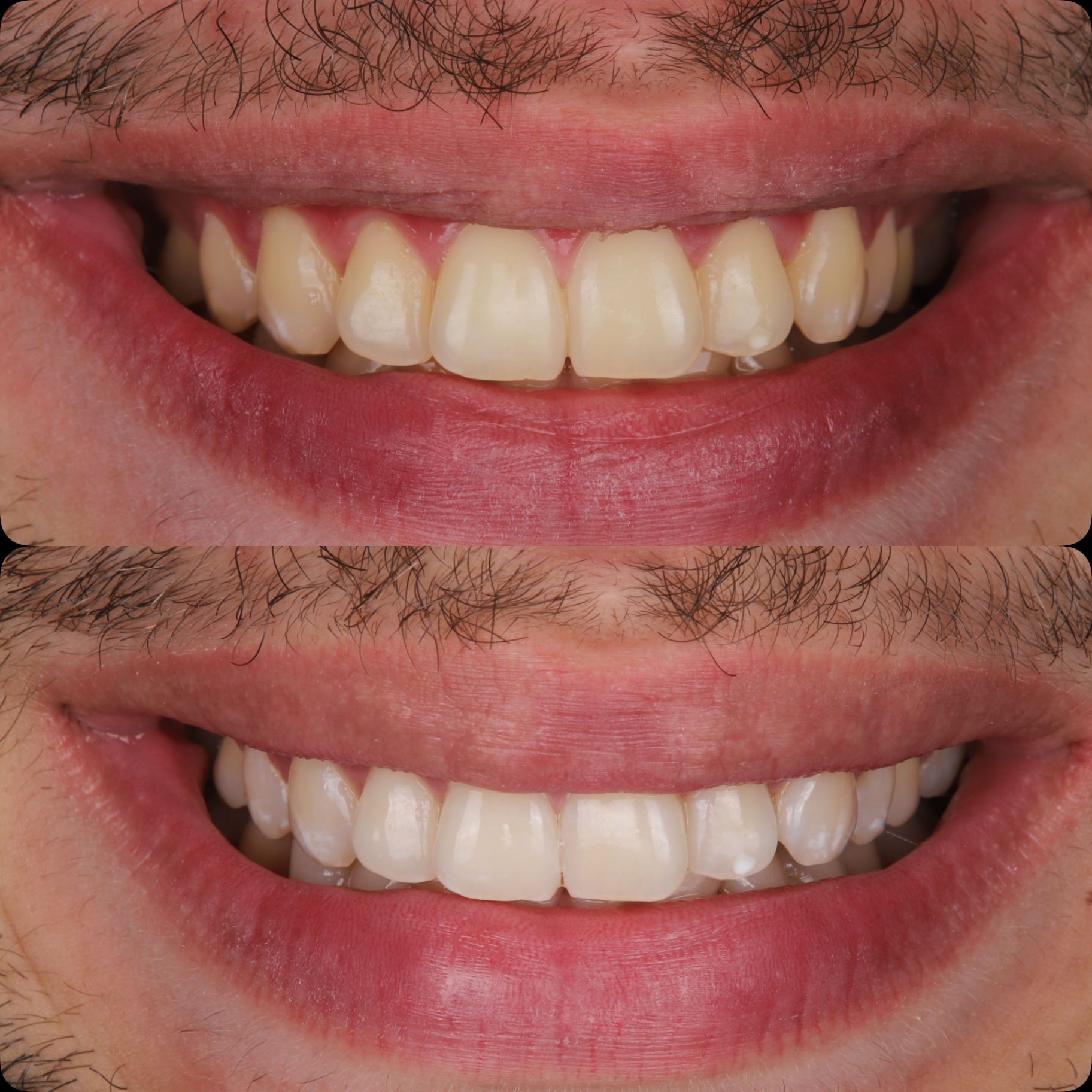Cas 1 — Avant / Après sourire : blanchiment dentaire professionnel avec détartrage et aéropolissage, Dr Yasser Guelzim, Cabinet Happiness Dental Center Maarif Casablanca